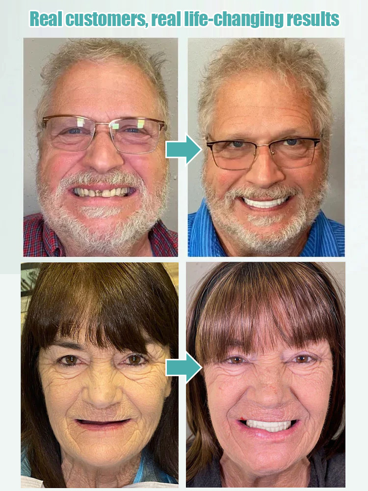 [Over 300,000 users worldwide] Full-mouth bone-supported denture set