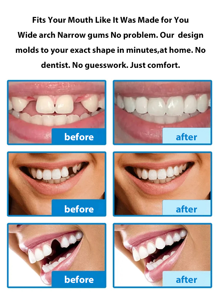 Natural Smile Denture Set – Over 200,000 units sold in just 3 days! ✨ 100% satisfaction guaranteed – Fixes yellowing teeth and missing teeth in seconds.