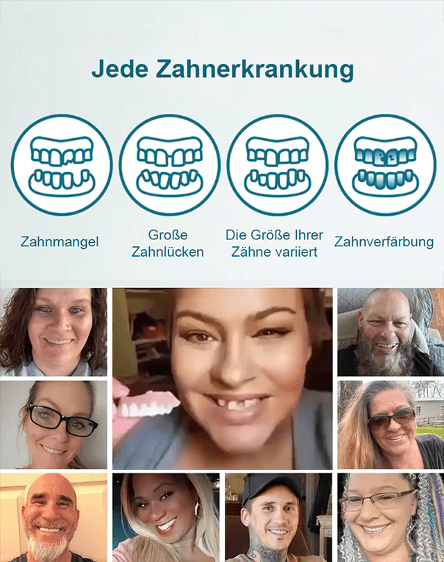 👍Für alle Zahntypen geeignet! Perfekte Passform in nur 1 Minuten. Zahnersatz-Veredelungsset für schöne Zähne