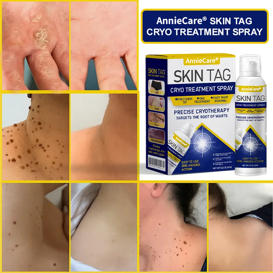 ⏰Last Day Promotion: 60% OFF🔥 AnnieCare® Skin Tag Cryo Treatment Spray