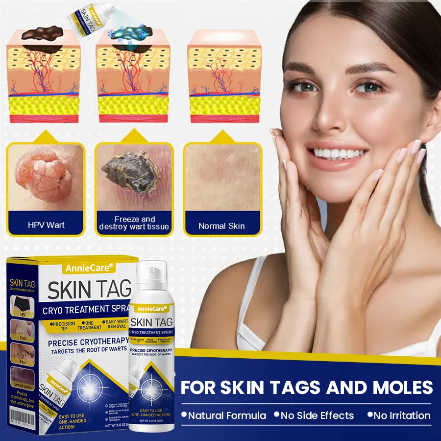 ⏰Last Day Promotion: 60% OFF🔥 AnnieCare® Skin Tag Cryo Treatment Spray