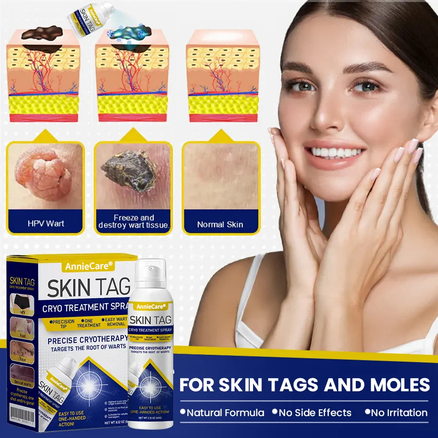 ⏰Last Day Promotion: 60% OFF🔥 AnnieCare® Skin Tag Cryo Treatment Spray