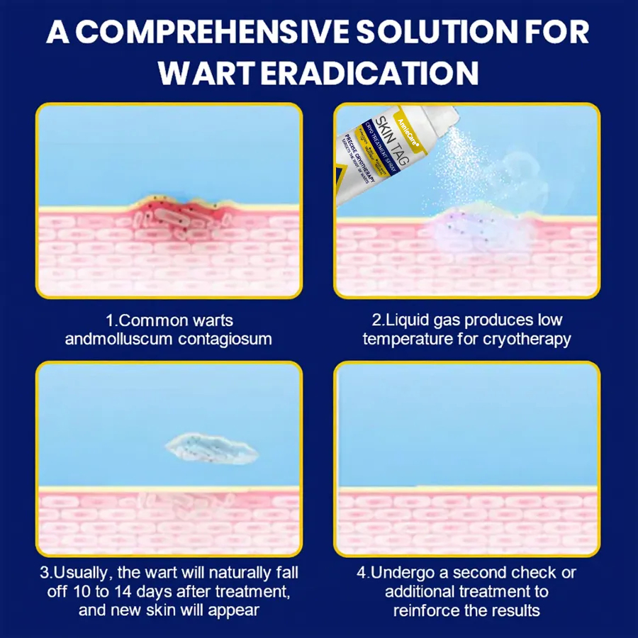 ⏰Last Day Promotion: 60% OFF🔥 AnnieCare® Skin Tag Cryo Treatment Spray