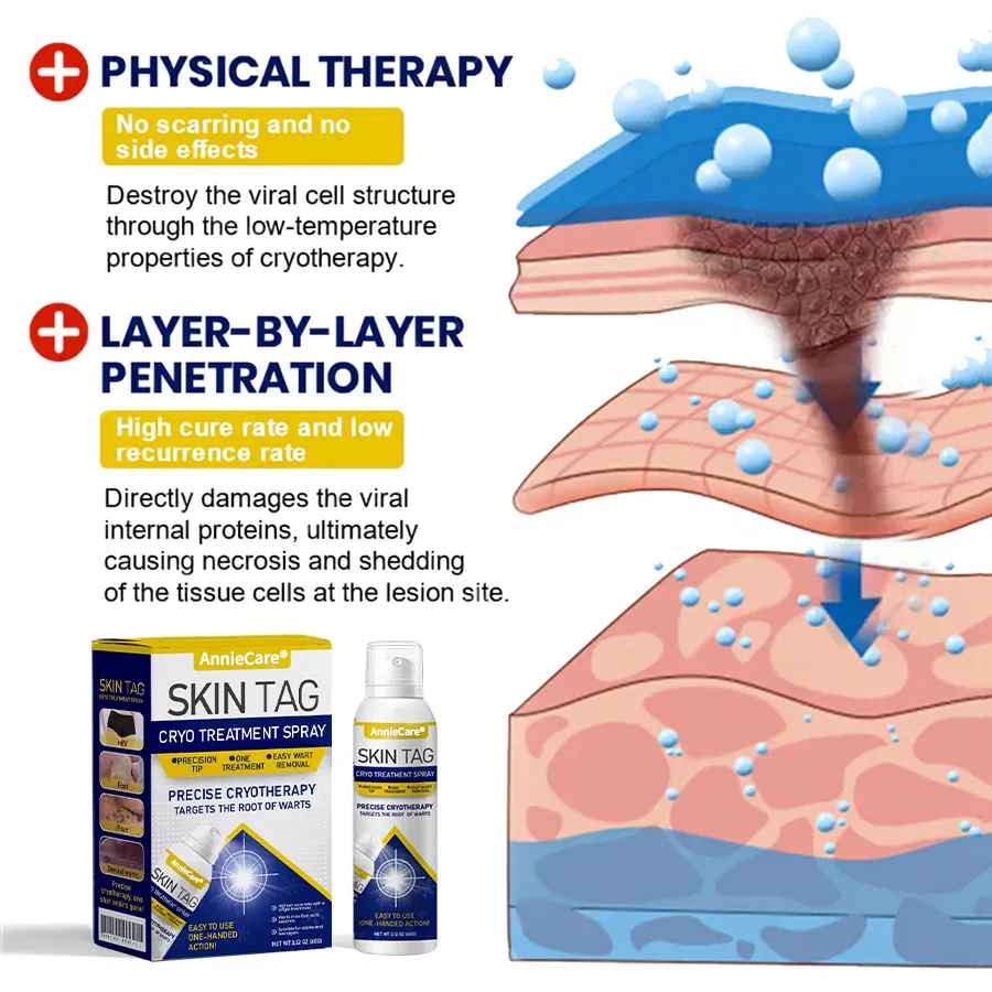 ⏰Last Day Promotion: 60% OFF🔥 AnnieCare® Skin Tag Cryo Treatment Spray