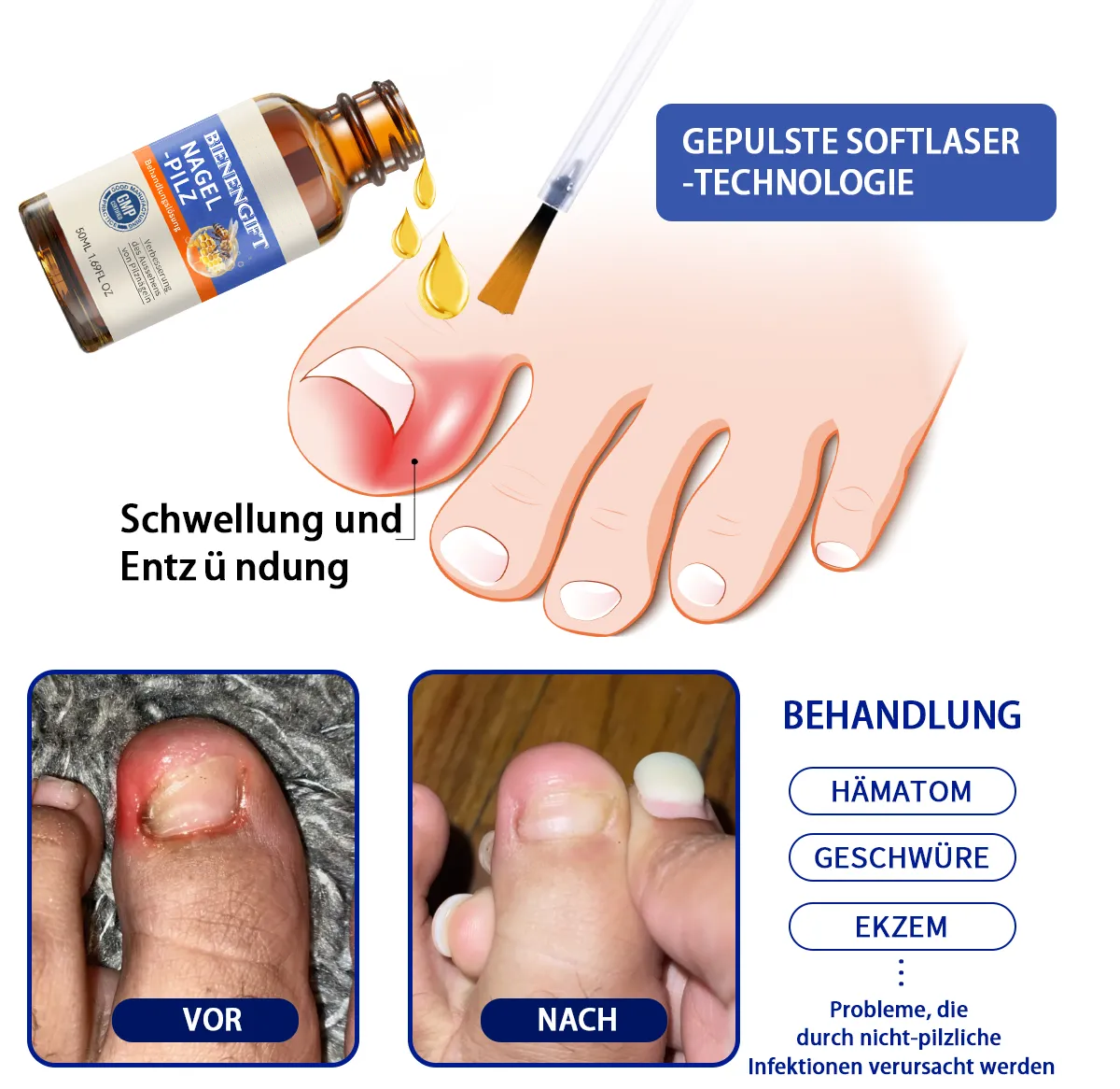 Anniecare® Bienengift Nagelpilz Behandlungslösung: Das Nagelpilzproblem vollständig lösen🌟