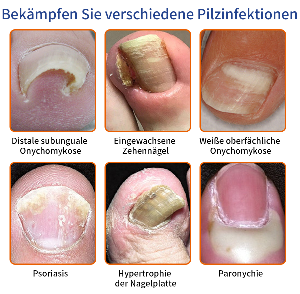 Furzero™ Bienengift Nagelpilz Behandlungslösung:Das Nagelpilzproblem vollständig lösen🌟