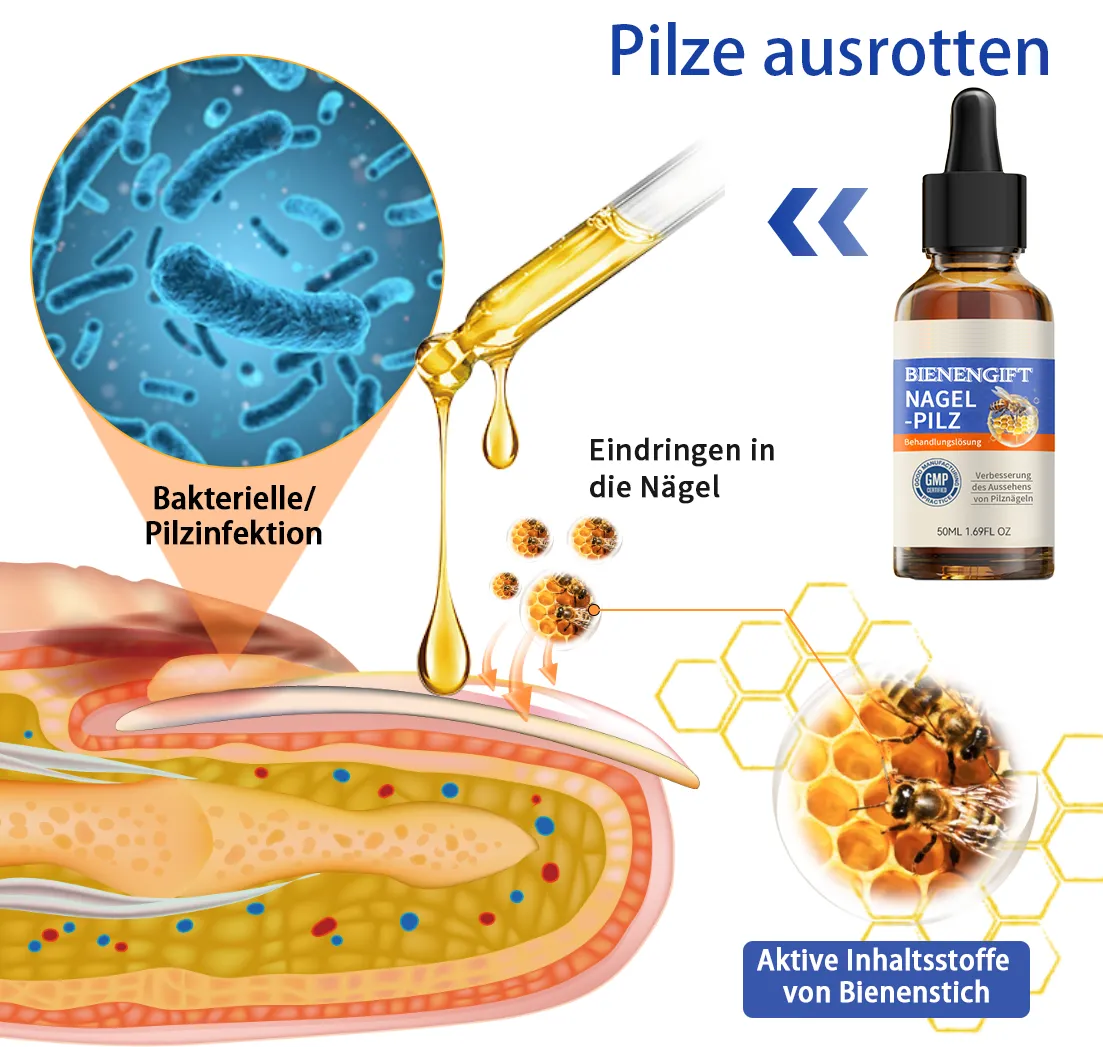 Anniecare® Bienengift Nagelpilz Behandlungslösung: Das Nagelpilzproblem vollständig lösen🌟