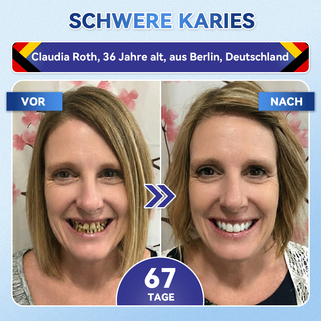 𝐺𝑙𝑖𝑚𝑚𝑒𝑟𝑙𝑦®🌳 Tideglusib Zahn & Zahnfleisch Schnelllösliche Repair-Mundstreifen