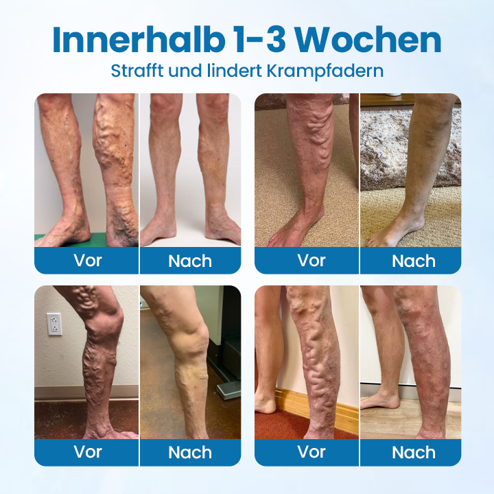 ✅Klinisch erwiesen, um Krampfadern in nur 7 Tagen zu beseitigen! - Timilk® 𝐕𝐞𝐢𝐧𝐆𝐮𝐚𝐫𝐝 𝐊𝐫ä𝐮𝐭𝐞𝐫𝐬𝐩𝐫𝐚𝐲