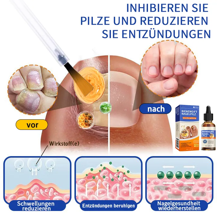 Anniecare® Bienengift Nagelpilz Behandlungslösung: Das Nagelpilzproblem vollständig lösen🌟