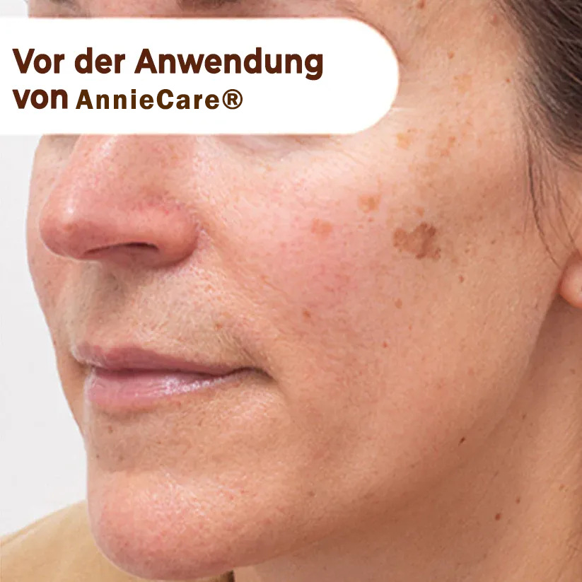 【𝐎𝐟𝐟𝐢𝐳𝐢𝐞𝐥𝐥𝐞𝐫 𝐅𝐥𝐚𝐠𝐬𝐡𝐢𝐩-𝐒𝐭𝐨𝐫𝐞】⏰Letzter Tag der Aktion: 60 % RABATT - 𝐀𝐧𝐧𝐢𝐞𝐂𝐚𝐫𝐞® 𝐇𝐞𝐫𝐛𝐚𝐥 𝐒𝐩𝐨𝐭𝐬 𝐏𝐞𝐞𝐥-𝐎𝐟𝐟-𝐆𝐞𝐬𝐢𝐜𝐡𝐭𝐬𝐦𝐚𝐬𝐤𝐞