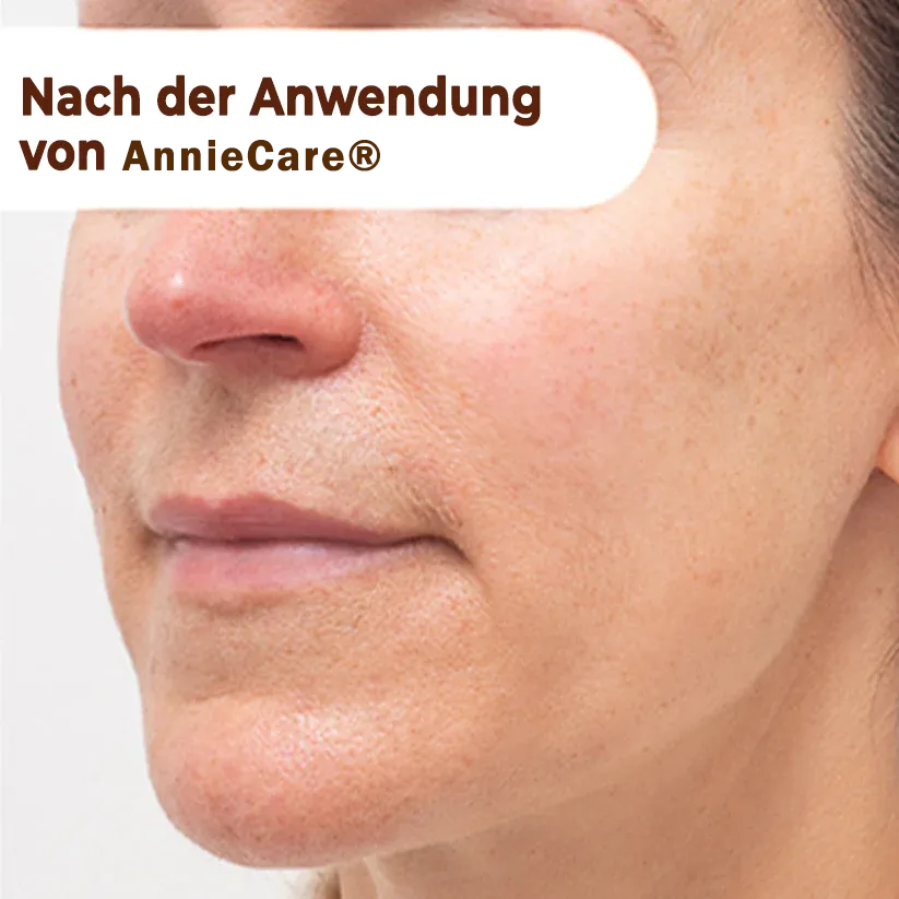 【𝐎𝐟𝐟𝐢𝐳𝐢𝐞𝐥𝐥𝐞𝐫 𝐅𝐥𝐚𝐠𝐬𝐡𝐢𝐩-𝐒𝐭𝐨𝐫𝐞】⏰Letzter Tag der Aktion: 60 % RABATT - 𝐀𝐧𝐧𝐢𝐞𝐂𝐚𝐫𝐞® 𝐇𝐞𝐫𝐛𝐚𝐥 𝐒𝐩𝐨𝐭𝐬 𝐏𝐞𝐞𝐥-𝐎𝐟𝐟-𝐆𝐞𝐬𝐢𝐜𝐡𝐭𝐬𝐦𝐚𝐬𝐤𝐞