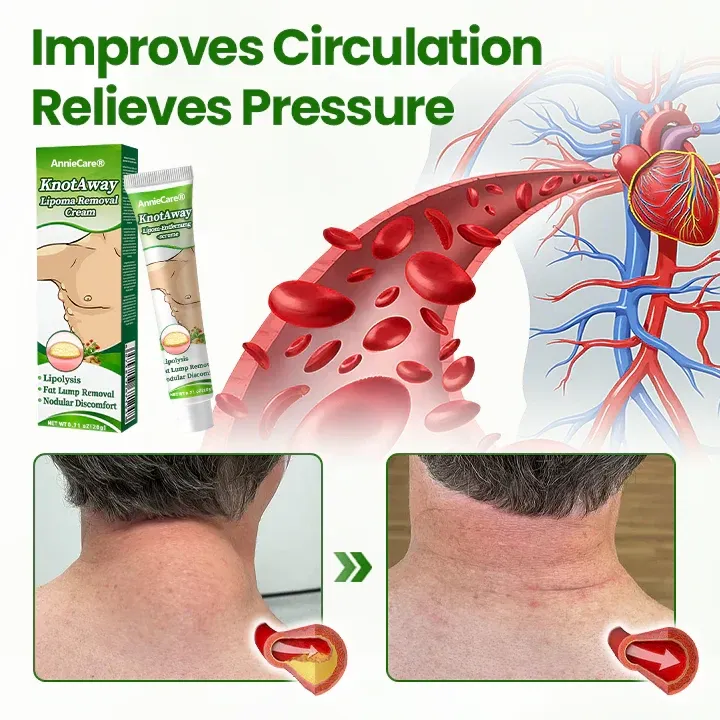 ⏰Last Day Promotion: 60% OFF🔥 Cvreoz® KnotAway Lipoma Removal Cream