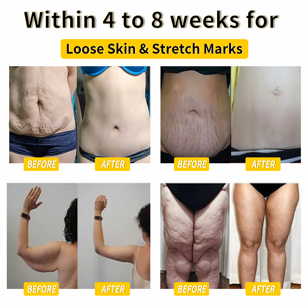 𝑨𝒏𝒏𝒊𝒆𝑪𝒂𝒓𝒆® 𝑩𝒊𝒆𝒏𝒆𝒏𝒈𝒊𝒇𝒕 𝑳𝒚𝒎𝒑𝒉𝒅𝒓𝒂𝒊𝒏𝒂𝒈𝒆 & 𝑯𝒂𝒖𝒕𝒔𝒕𝒓𝒂𝒇𝒇𝒆𝒏𝒅𝒆 𝑺𝒍𝒊𝒎𝒎𝒊𝒏𝒈-𝑪𝒓𝒆𝒎𝒆 🐝