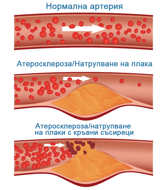 1703575095653448.jpg atherosclerosis.jpg