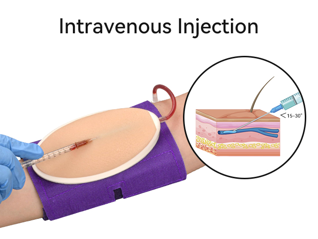 Intravenous Injection Explained: Definition, Sites, and Applications