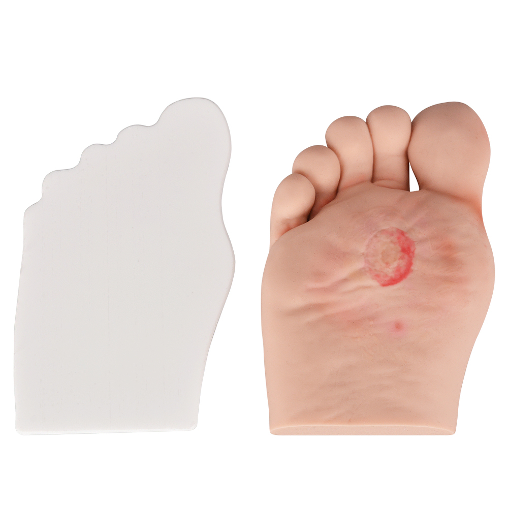 Stage1 Diabetic Foot Model