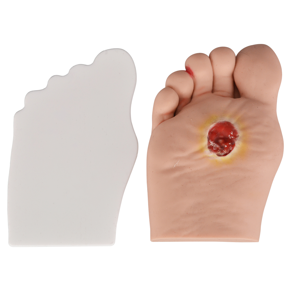 Stage2 Diabetic Foot Model