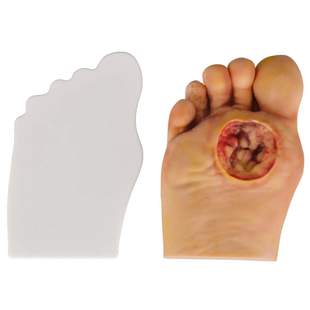 Stage4 Diabetic Foot Model
