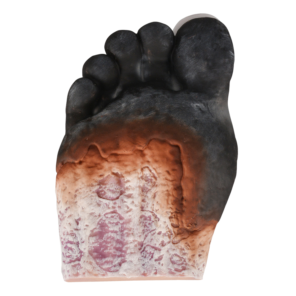Stage 5 Diabetic Foot Model