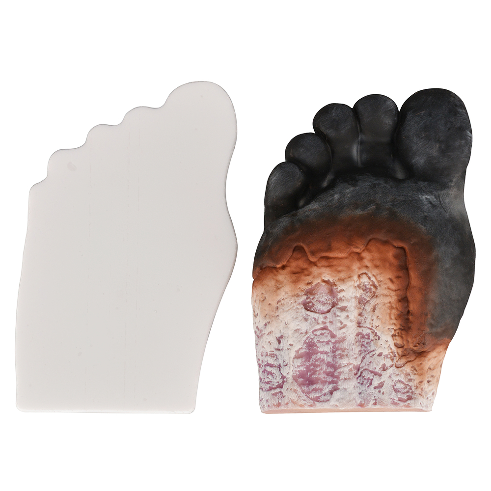 Stage5 Diabetic Foot Model
