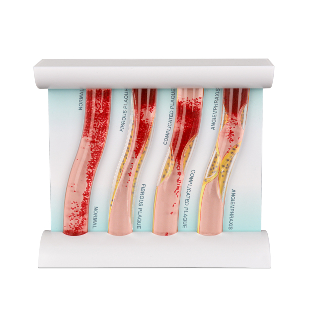 Upgraded Low-Density Lipoprotein LDL Blood Vessel Model