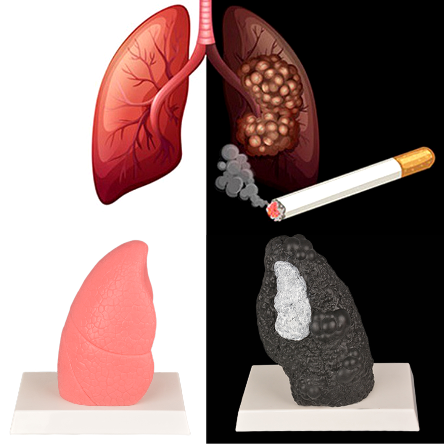 Normal Lung vs Smoker Lung Anatomy Model