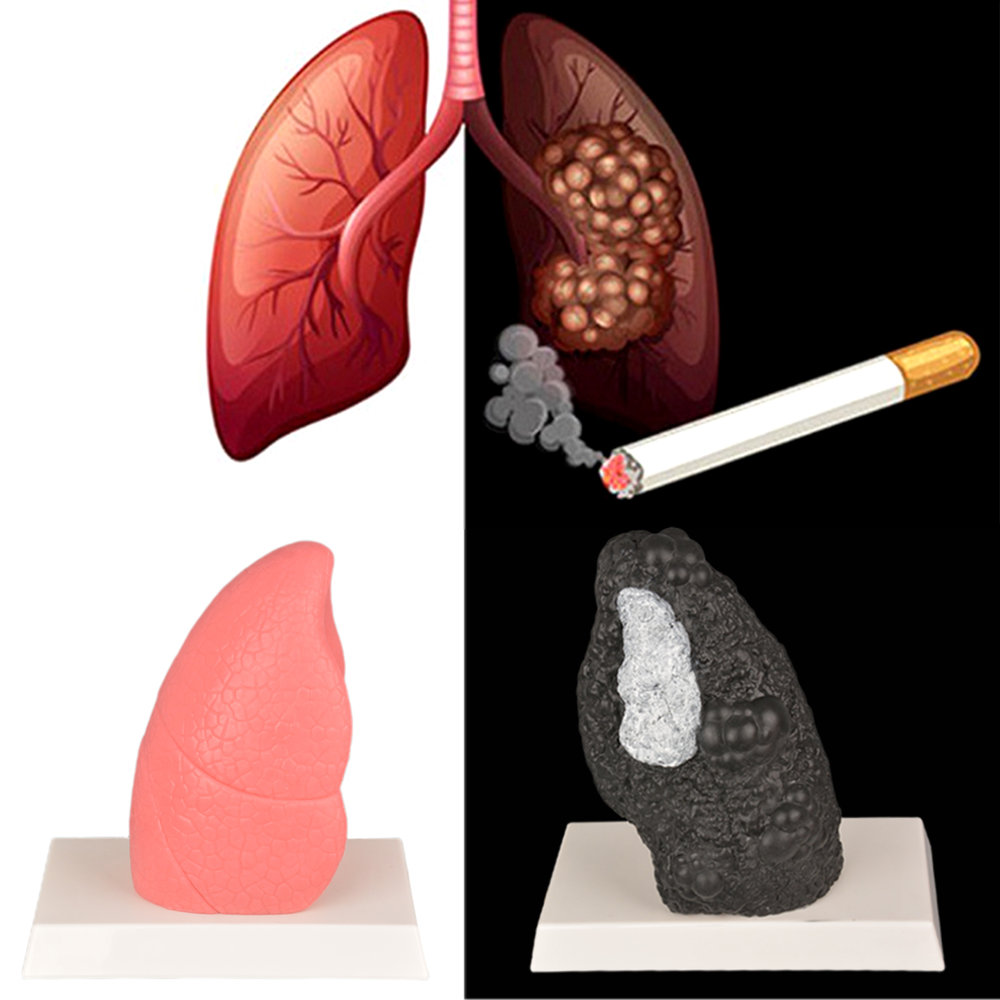 Normal Lung vs Smoker Lung Anatomy Model