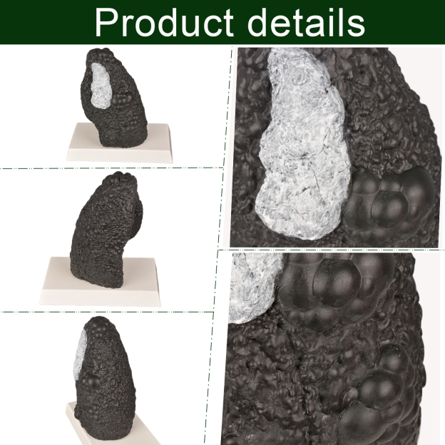 Normal Lung vs Smoker Lung Anatomy Model