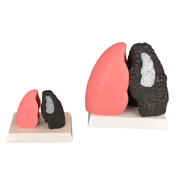 Normal Lung vs Smoker Lung Anatomy Model