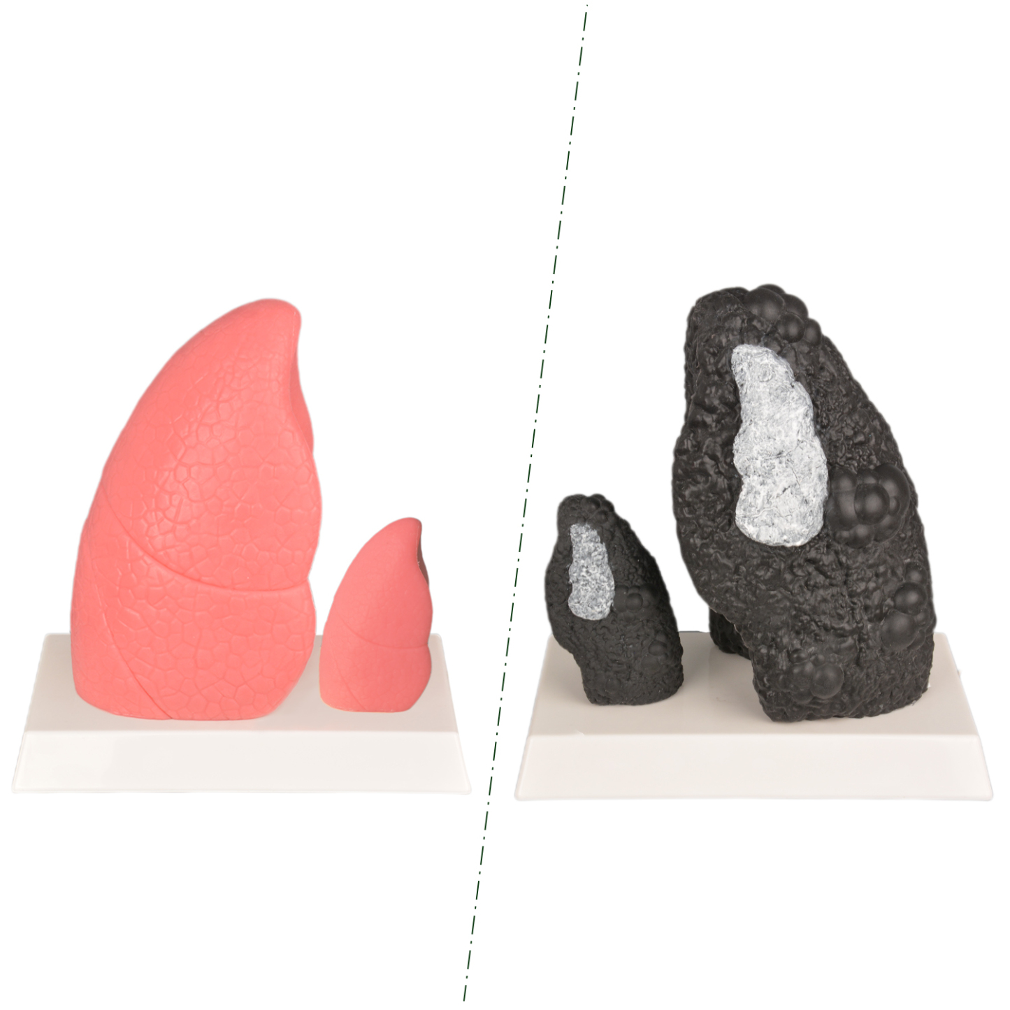 Normal Lung vs Smoker Lung Anatomy Model