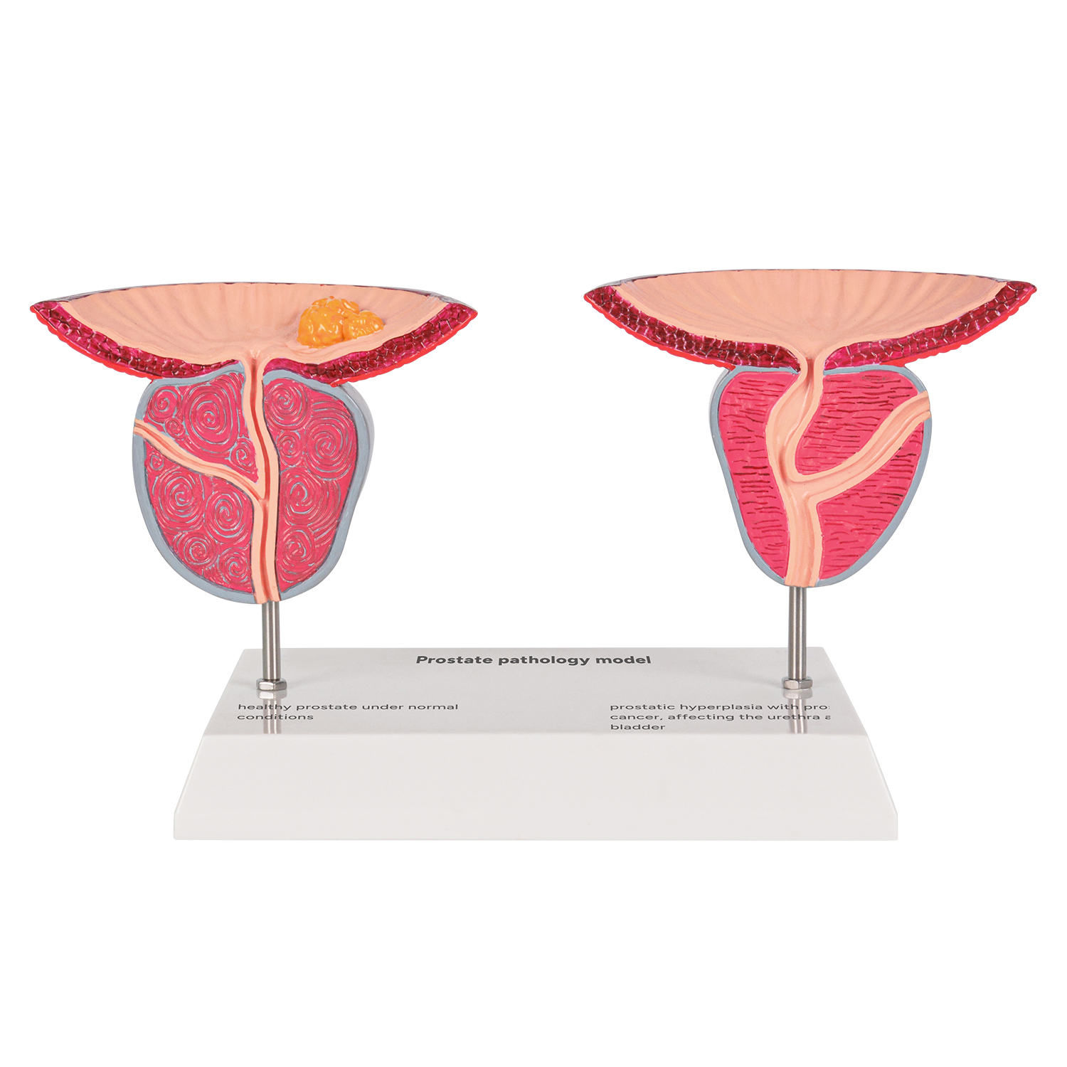 Prostate Disease Comparison Model