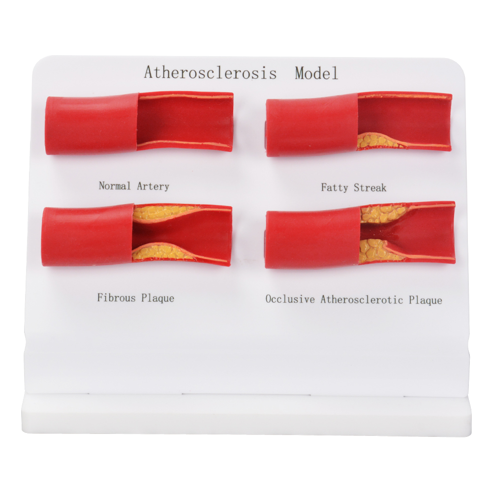 Atherosclerosis Progression Model
