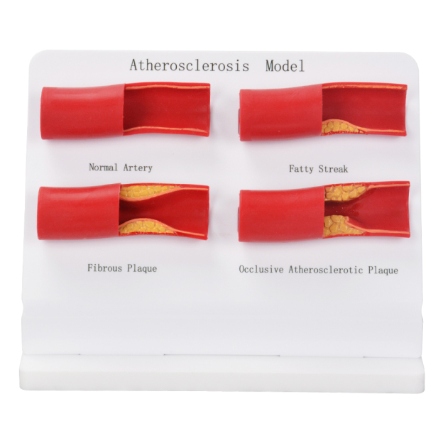 Atherosclerosis Progression Model