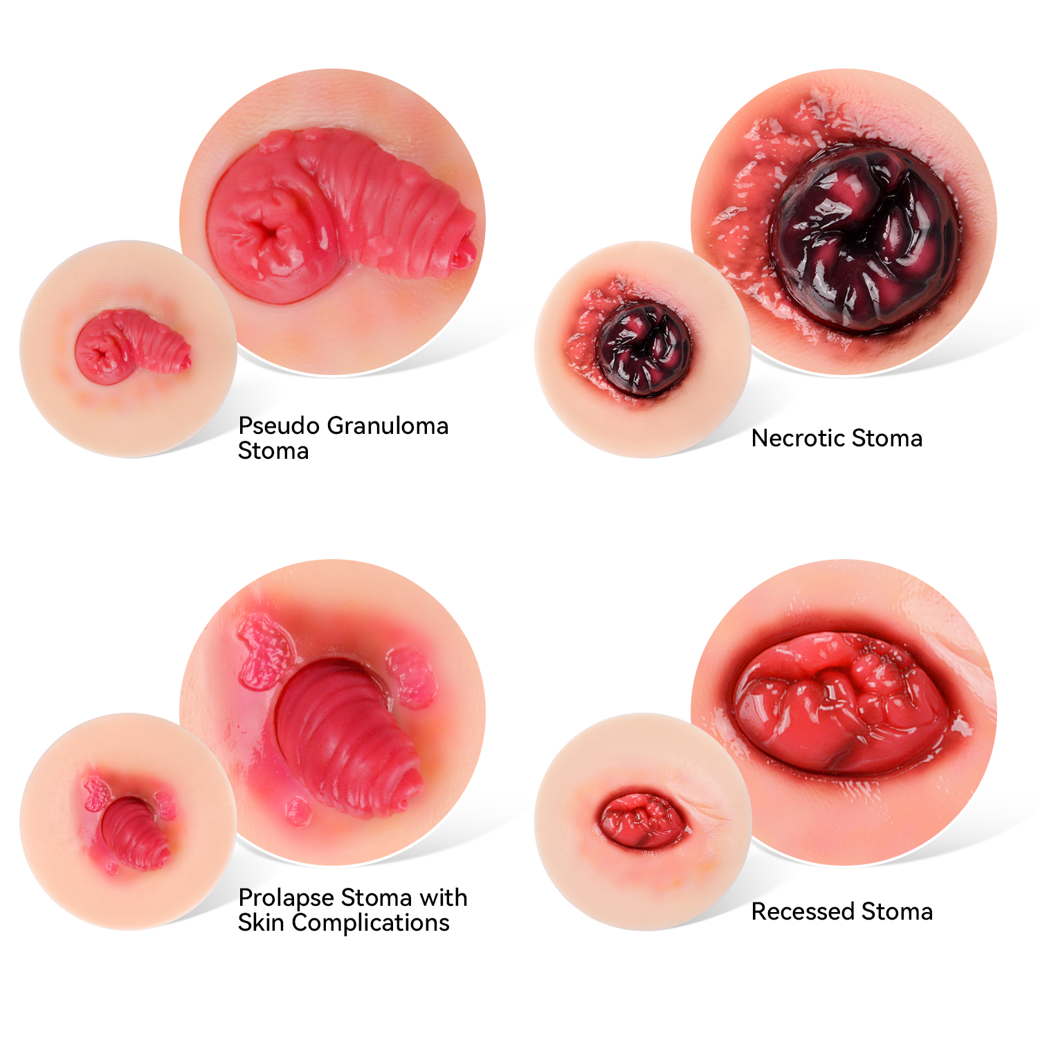 Abnormal Ostomy Care Training Model