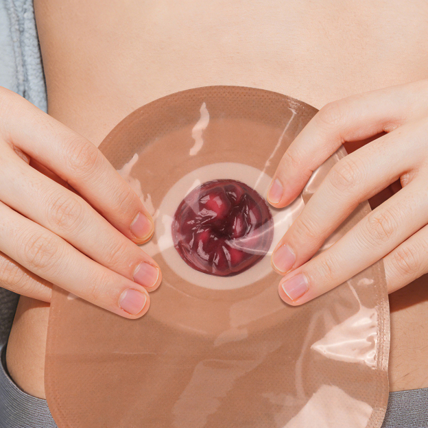 Abnormal Ostomy Care Training Model
