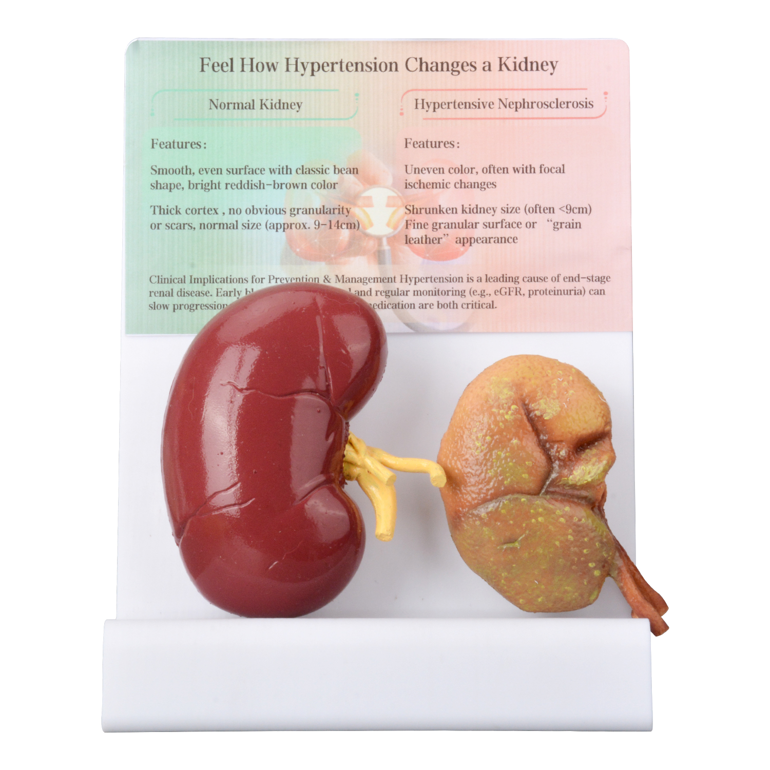 Human Hypertensive Kidney & Normal Kidney Comparison Model