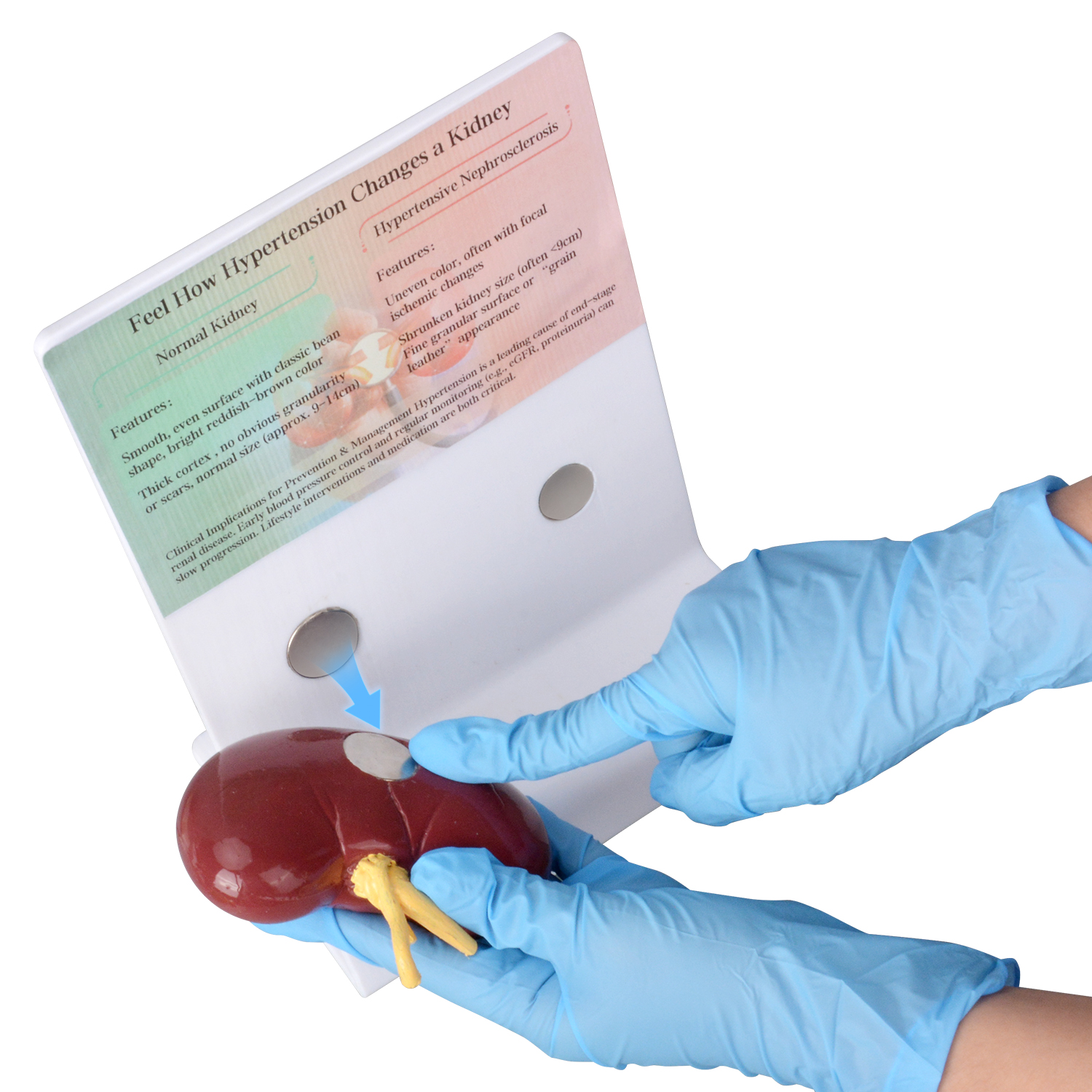 Human Hypertensive Kidney & Normal Kidney Comparison Model