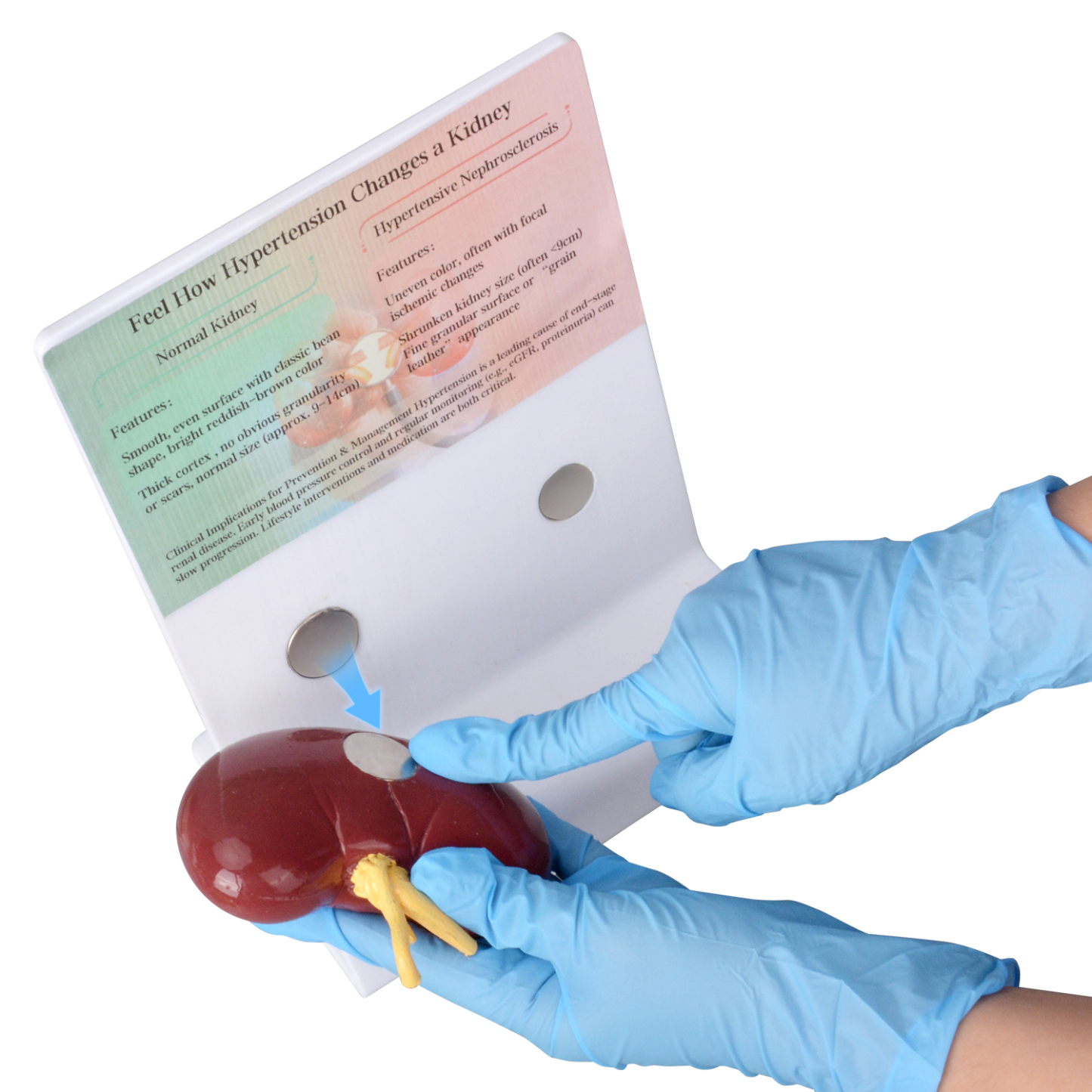 Human Hypertensive Kidney & Normal Kidney Comparison Model