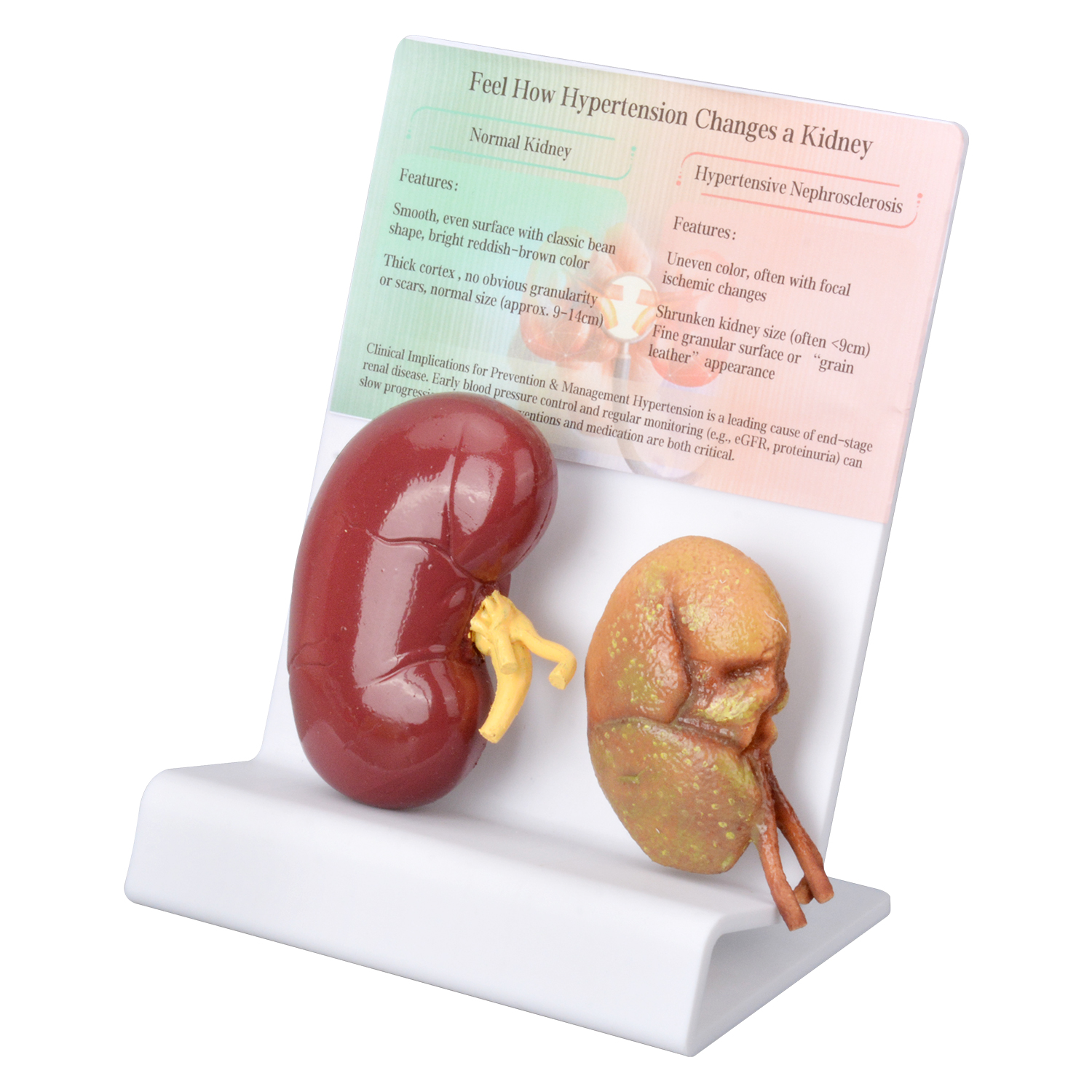 Human Hypertensive Kidney & Normal Kidney Comparison Model