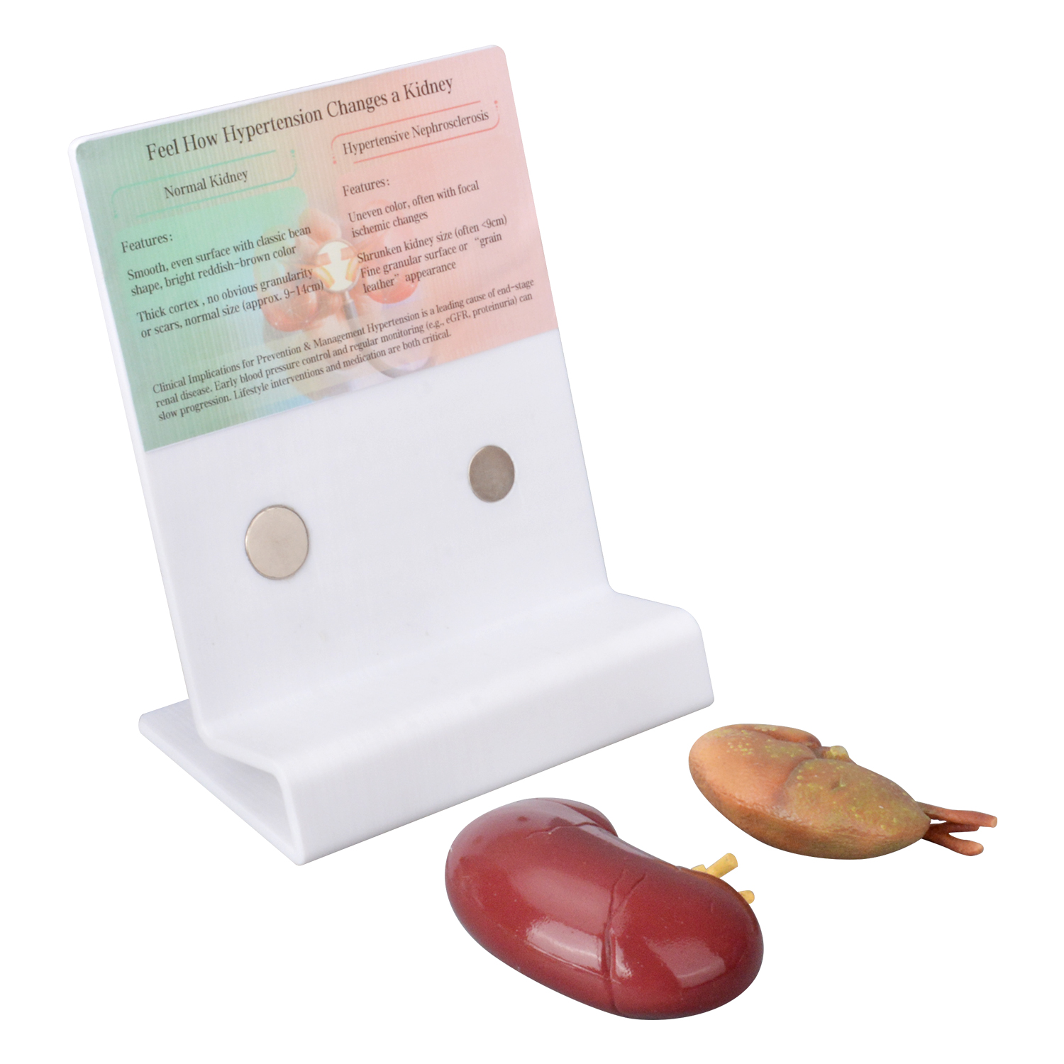 Human Hypertensive Kidney & Normal Kidney Comparison Model