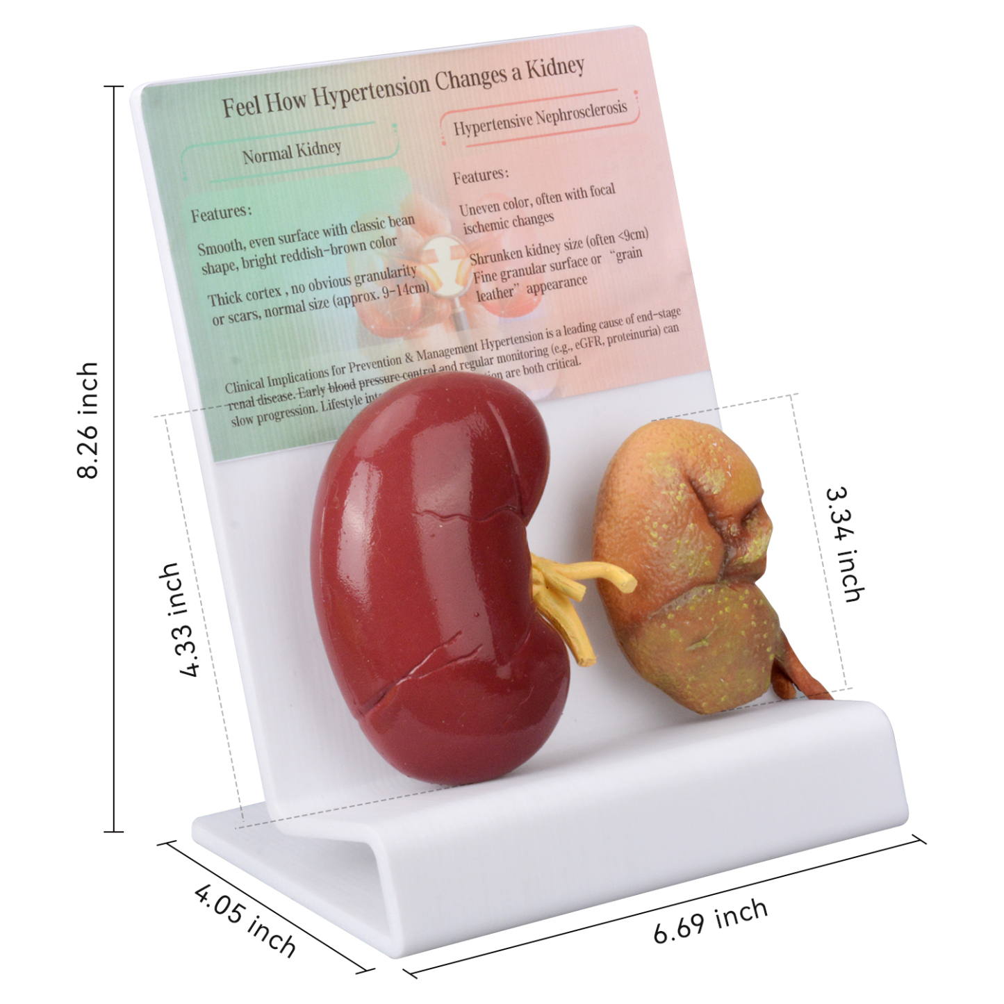 Human Hypertensive Kidney & Normal Kidney Comparison Model