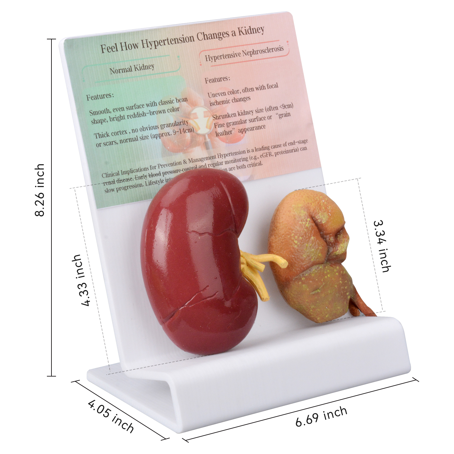 Human Hypertensive Kidney & Normal Kidney Comparison Model