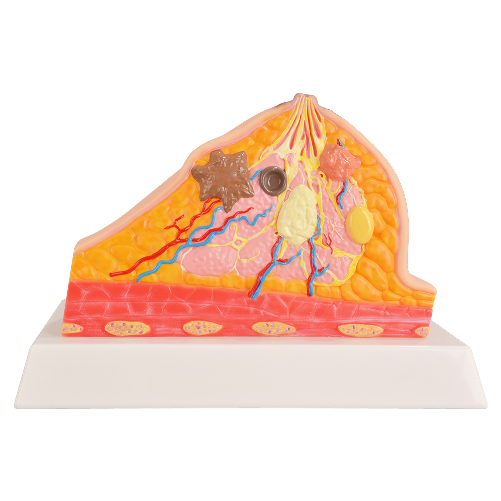 Cross Section Breast Anatomy Model Showing Common Conditions