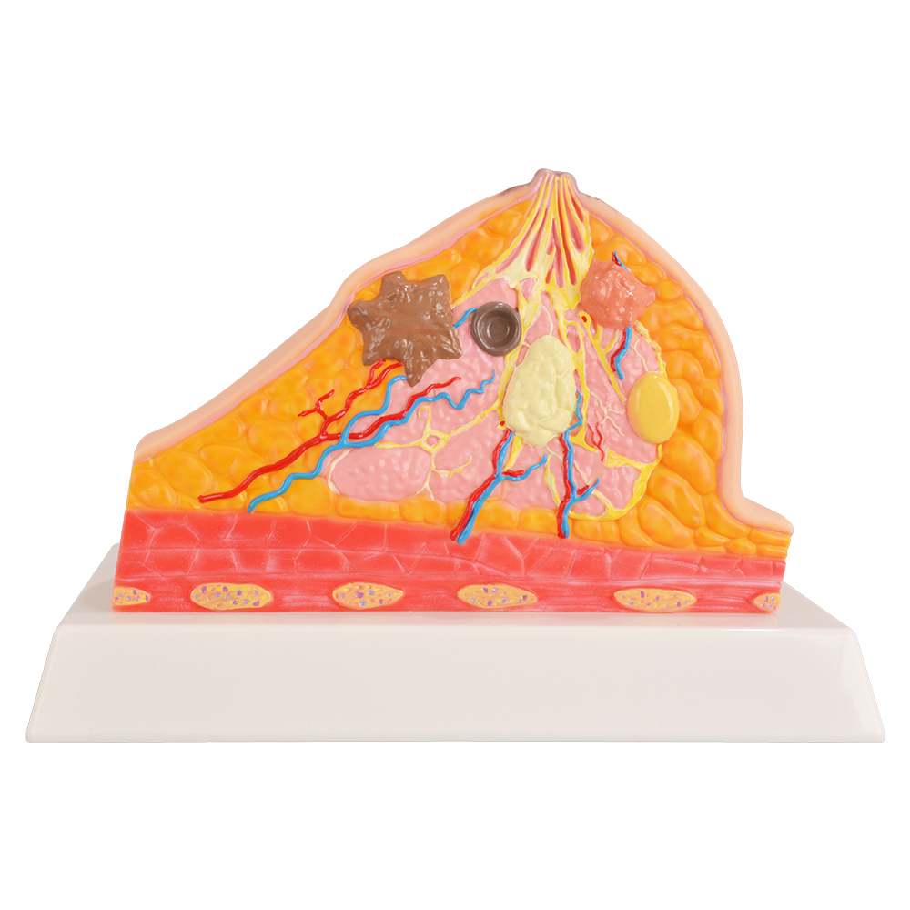 Cross Section Breast Anatomy Model Showing Common Conditions