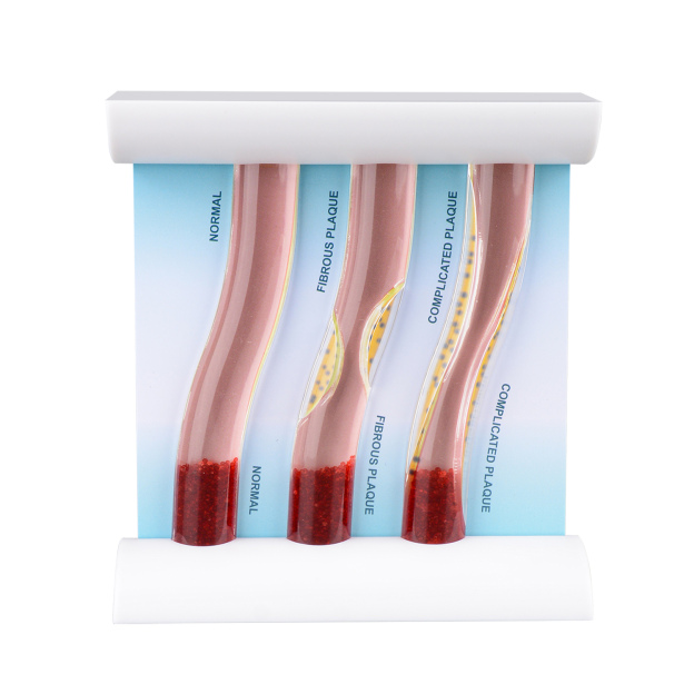3-Vessel Blood Vessel Model, Normal vs Blocked Arteries from High LDL