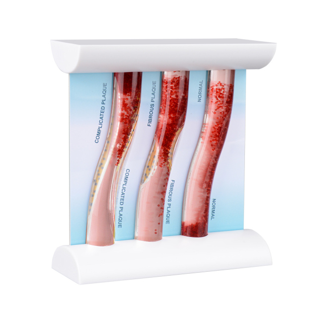 3-Vessel Blood Vessel Model, Normal vs Blocked Arteries from High LDL