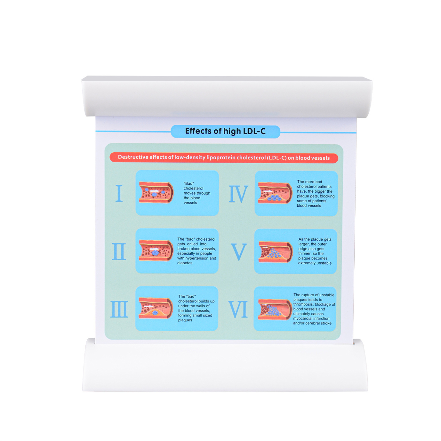 3-Vessel Blood Vessel Model, Normal vs Blocked Arteries from High LDL