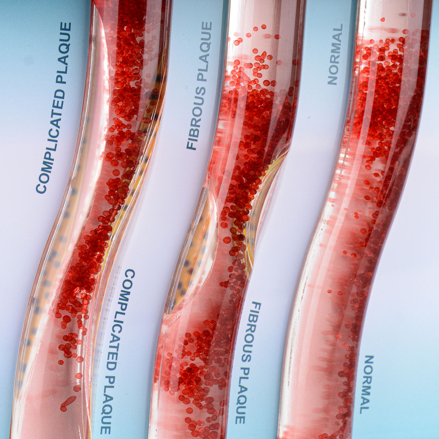 3-Vessel Blood Vessel Model, Normal vs Blocked Arteries from High LDL