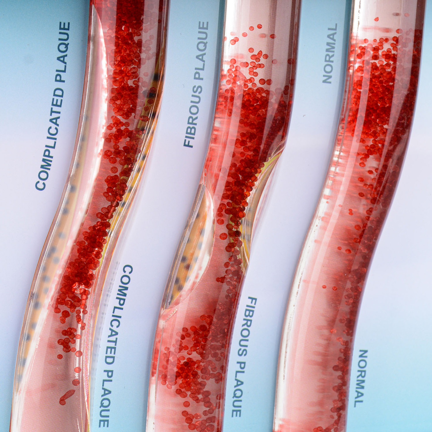3-Vessel Blood Vessel Model, Normal vs Blocked Arteries from High LDL